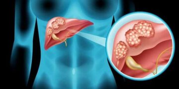 Dự báo tỷ lệ ung thư gan tăng cao vào năm 2040