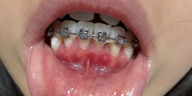 ThS.BS. Nguyễn Quang Tiến – CEO Bệnh viện Răng Hàm Mặt Sài Gòn: Một số sai lầm khi niềng răng nhiều người Việt thường xuyên mắc phải